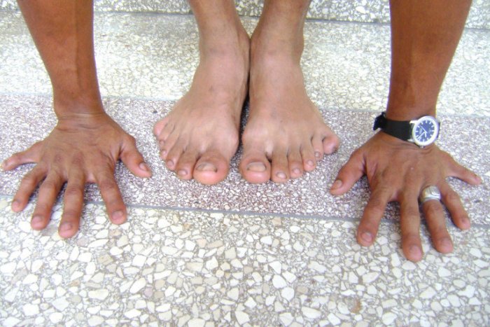 Особенные: 10 необычных аномалий человеческого тела