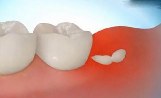 Перикоронит: лечение в стоматологии и в домашних условиях Перикоронит: лечение в стоматологии и в домашних условиях