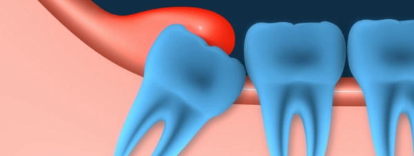 Перикоронит: лечение в стоматологии и в домашних условиях Перикоронит: лечение в стоматологии и в домашних условиях