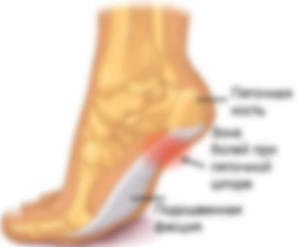 Так ли легко вылечить пяточную шпору?