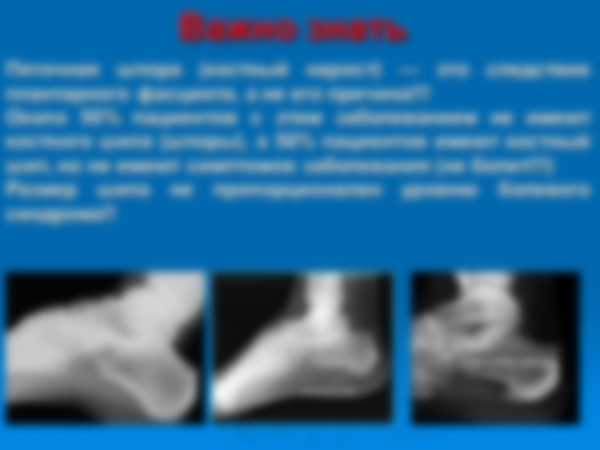 Так ли легко вылечить пяточную шпору?