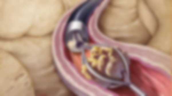 Камни в почках у женщин - симптомы и лечение