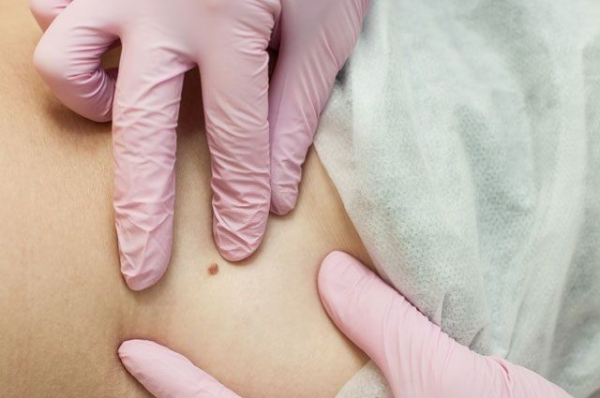 Что собой представляет вирус папилломы человека, чем он опасен и как себя защитить