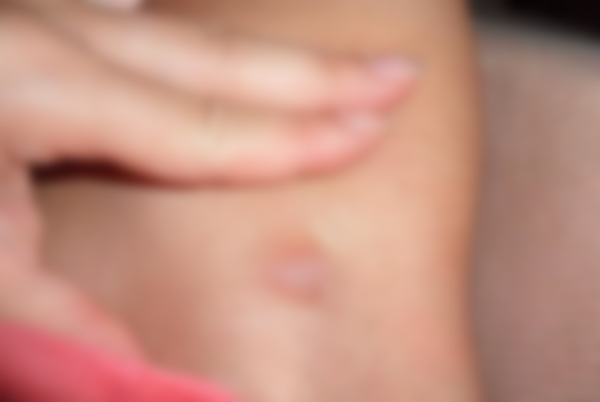 Уплотнение под кожей в виде шарика Уплотнение под кожей в виде шарика