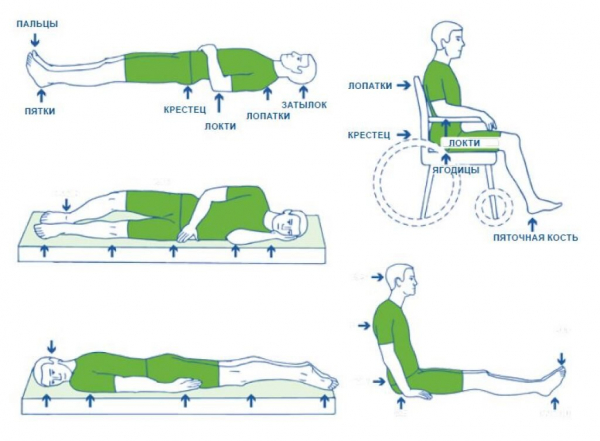 Пролежни: что это, где и почему появляются Пролежни: что это, где и почему появляются