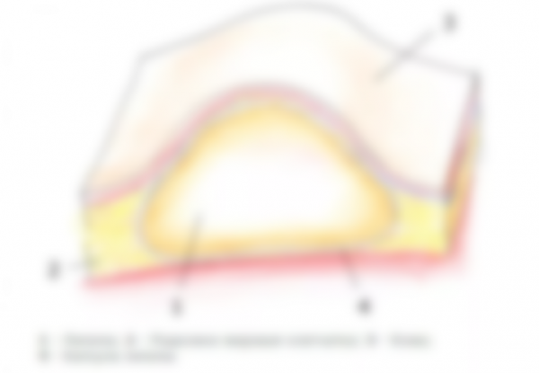Уплотнение под кожей в виде шарика Уплотнение под кожей в виде шарика