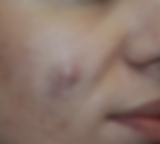 Уплотнение под кожей в виде шарика Уплотнение под кожей в виде шарика