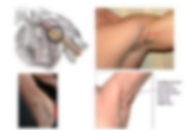 Уплотнение под кожей в виде шарика Уплотнение под кожей в виде шарика