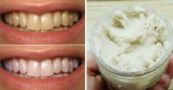 Как американки отбеливают зубы: почему масло лучше, чем привычная паста Как американки отбеливают зубы: почему масло лучше, чем привычная паста