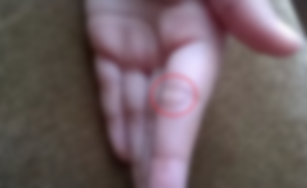 Уплотнение под кожей в виде шарика Уплотнение под кожей в виде шарика