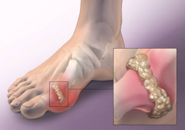 Подагра, стоп! Как всего 1 средство поможет избавиться от боли и внешних признаков. Эффект придет постепенно, но ты его увидишь. Подагра, стоп! Как всего 1 средство поможет избавиться от боли и внешних признаков. Эффект придет постепенно, но ты его увидишь.