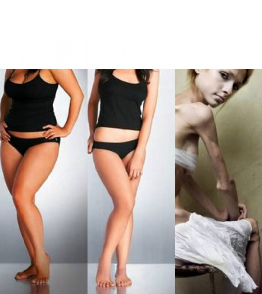 Последствия «Экстрим похудения»