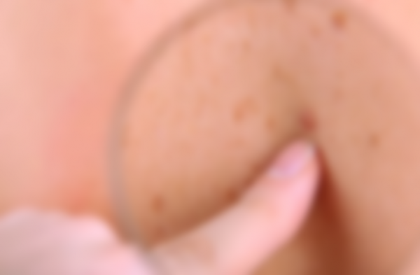 Уплотнение под кожей в виде шарика Уплотнение под кожей в виде шарика