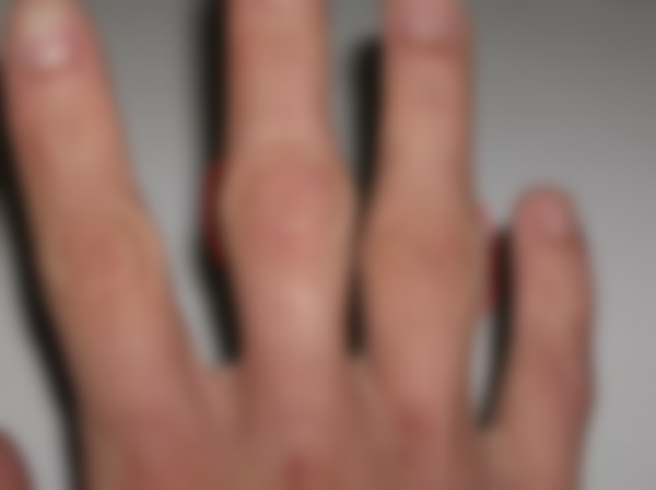 Уплотнение под кожей в виде шарика Уплотнение под кожей в виде шарика