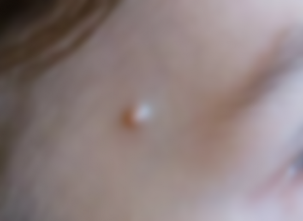 Уплотнение под кожей в виде шарика Уплотнение под кожей в виде шарика