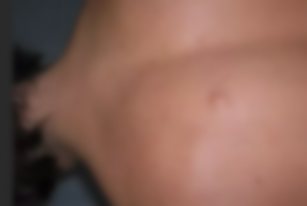 Уплотнение под кожей в виде шарика Уплотнение под кожей в виде шарика