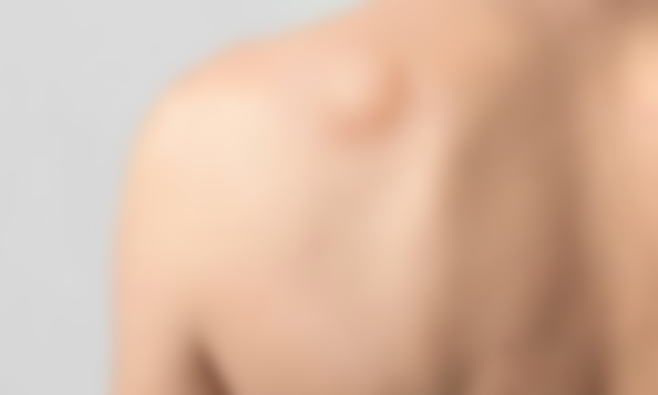 Уплотнение под кожей в виде шарика Уплотнение под кожей в виде шарика