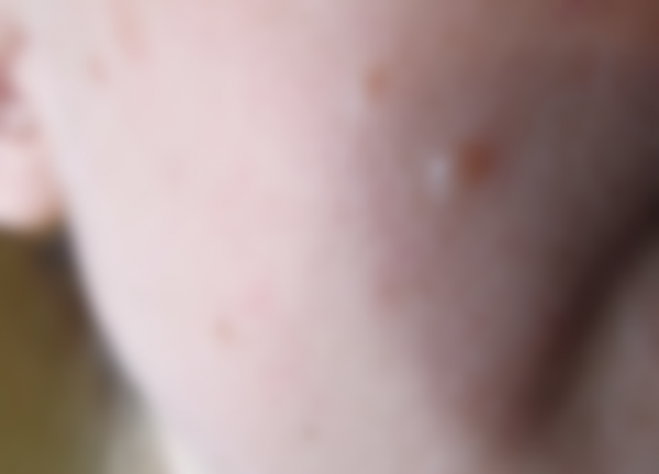 Уплотнение под кожей в виде шарика Уплотнение под кожей в виде шарика