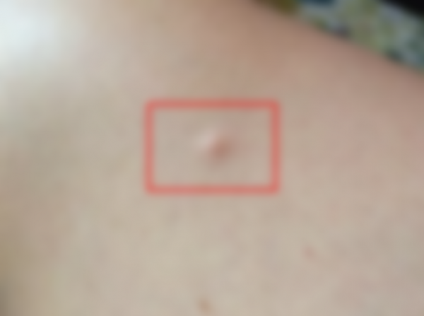 Уплотнение под кожей в виде шарика Уплотнение под кожей в виде шарика