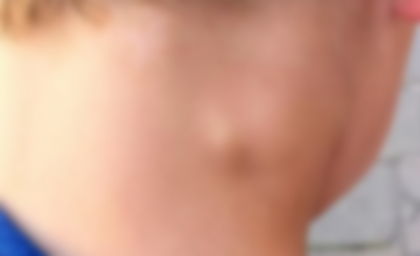 Уплотнение под кожей в виде шарика Уплотнение под кожей в виде шарика