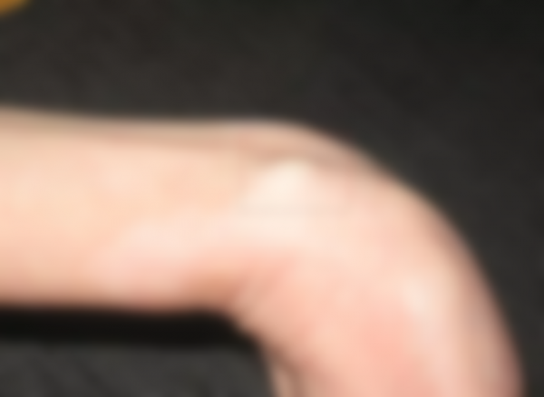 Уплотнение под кожей в виде шарика Уплотнение под кожей в виде шарика