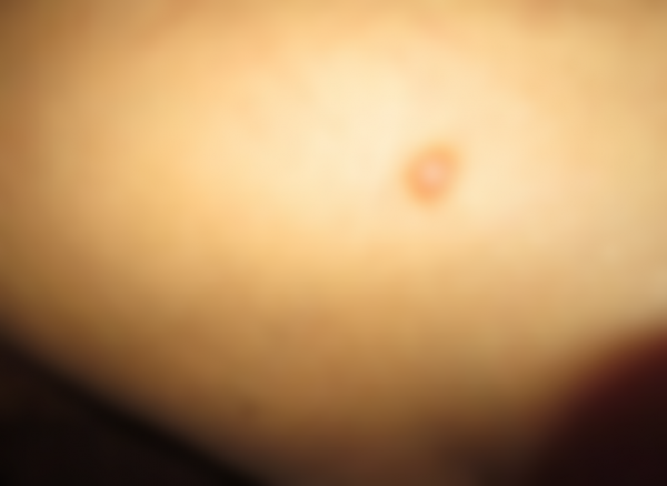 Уплотнение под кожей в виде шарика Уплотнение под кожей в виде шарика