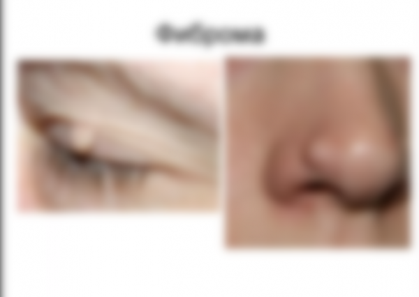 Уплотнение под кожей в виде шарика Уплотнение под кожей в виде шарика