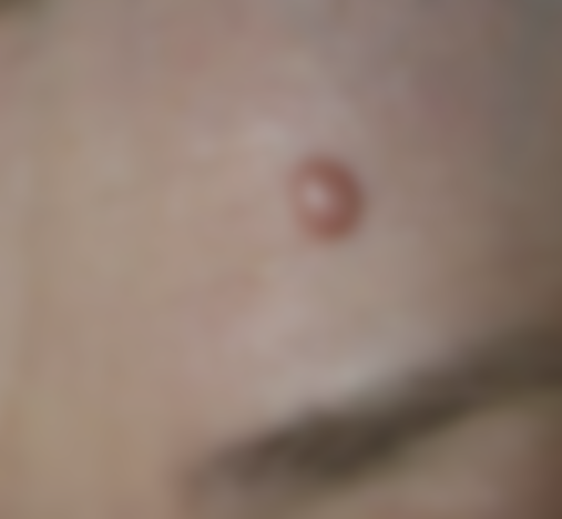 Уплотнение под кожей в виде шарика Уплотнение под кожей в виде шарика