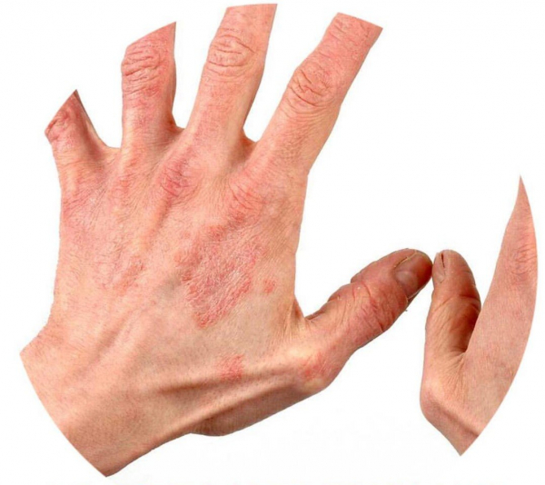 Лечим лишай в домашних условиях