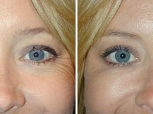 Прыщи на теле Прыщи на теле