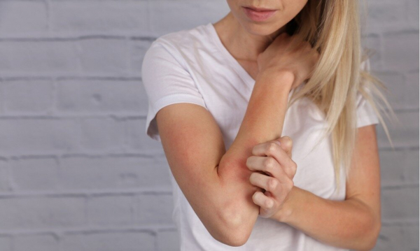 Не вылечить, но облегчить: 9 советов, которые помогут предотвратить обострение экземы Не вылечить, но облегчить: 9 советов, которые помогут предотвратить обострение экземы