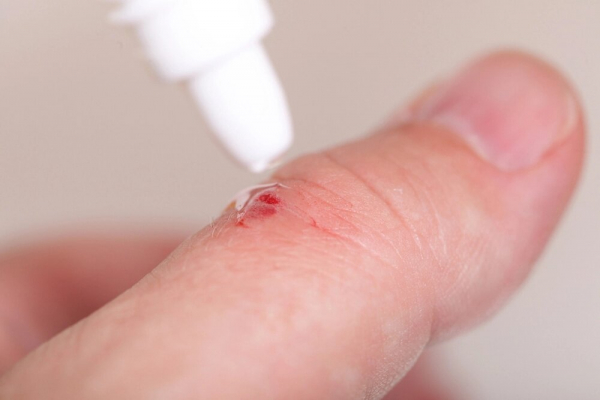 Перекись водорода или хлоргексидин: что выбрать? Перекись водорода или хлоргексидин: что выбрать?