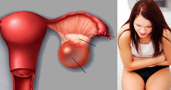 Подавленные эмоции и стресс: какова психосоматика кисты яичника