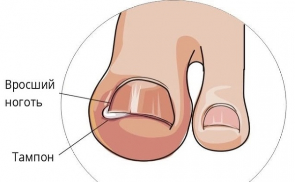 Как победить вросший ноготь и грибок на ногах Как победить вросший ноготь и грибок на ногах